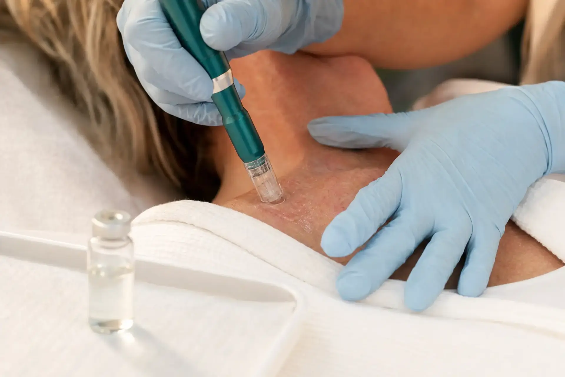 Kombination von Polynukleotiden und Microneedling im Behandlungsprotokoll bei MAP