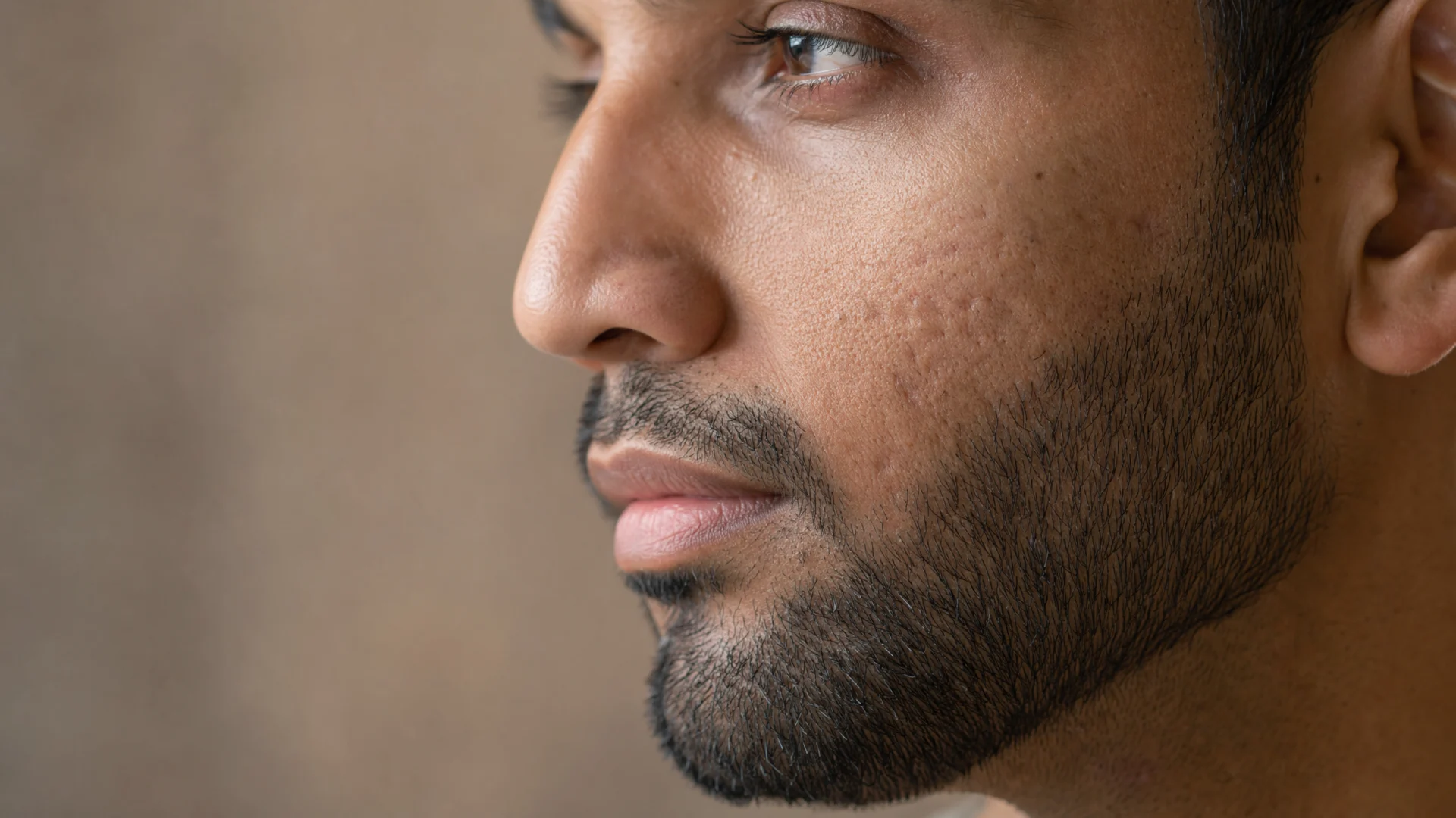 Microneedling Gesicht: Wange mit natürlicher Hautstruktur und feinen Aknespuren, Longevity Aesthetics MAP